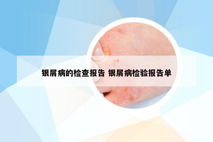 银屑病的检查报告 银屑病检验报告单