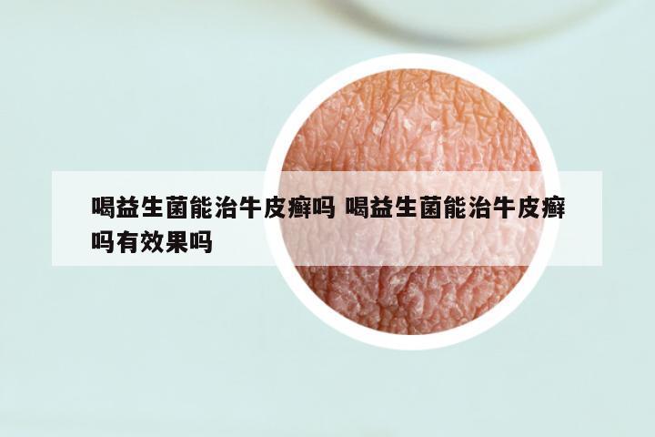 喝益生菌能治牛皮癣吗 喝益生菌能治牛皮癣吗有效果吗