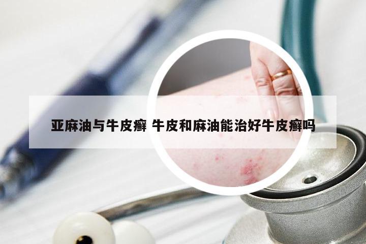 亚麻油与牛皮癣 牛皮和麻油能治好牛皮癣吗