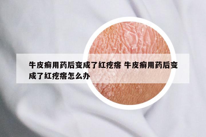 牛皮癣用药后变成了红疙瘩 牛皮癣用药后变成了红疙瘩怎么办