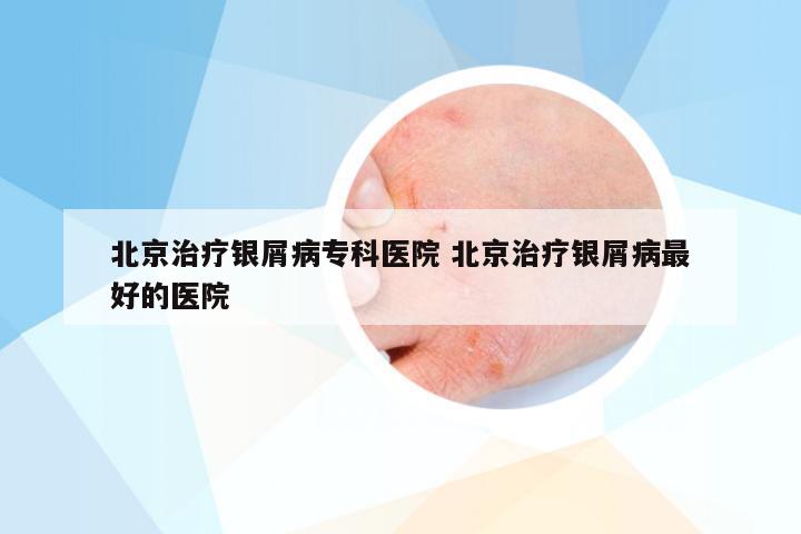 北京治疗银屑病专科医院 北京治疗银屑病最好的医院