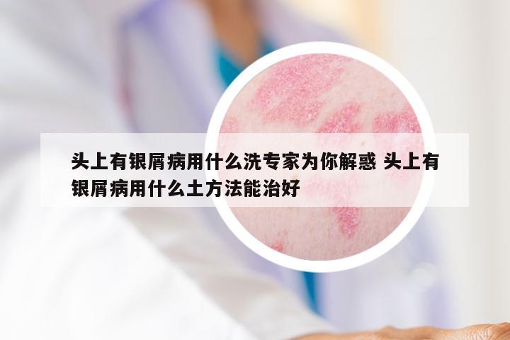 头上有银屑病用什么洗专家为你解惑 头上有银屑病用什么土方法能治好