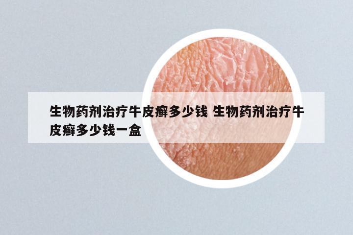 生物药剂治疗牛皮癣多少钱 生物药剂治疗牛皮癣多少钱一盒