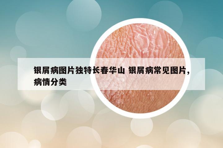 银屑病图片独特长春华山 银屑病常见图片,病情分类