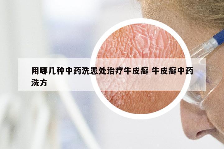 用哪几种中药洗患处治疗牛皮癣 牛皮癣中药洗方