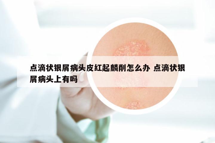点滴状银屑病头皮红起麟削怎么办 点滴状银屑病头上有吗