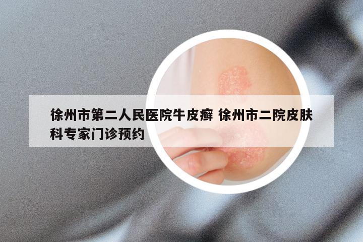 徐州市第二人民医院牛皮癣 徐州市二院皮肤科专家门诊预约