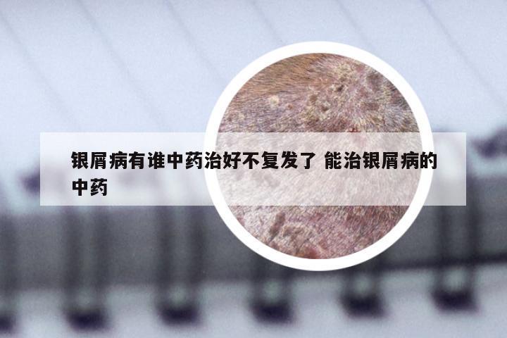 银屑病有谁中药治好不复发了 能治银屑病的中药