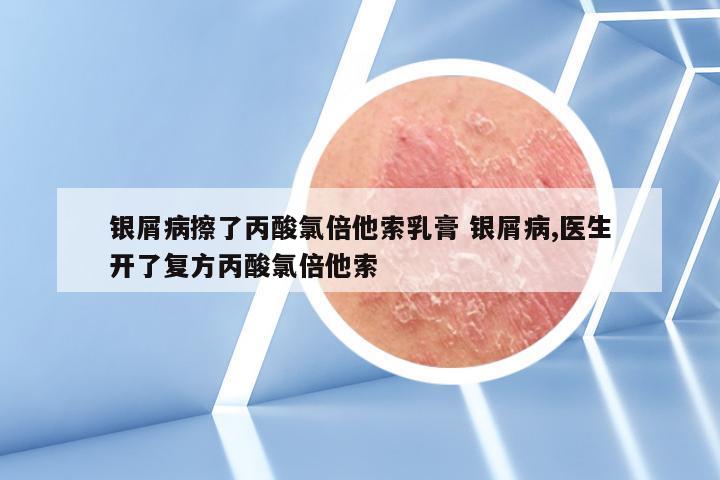 银屑病擦了丙酸氯倍他索乳膏 银屑病,医生开了复方丙酸氯倍他索