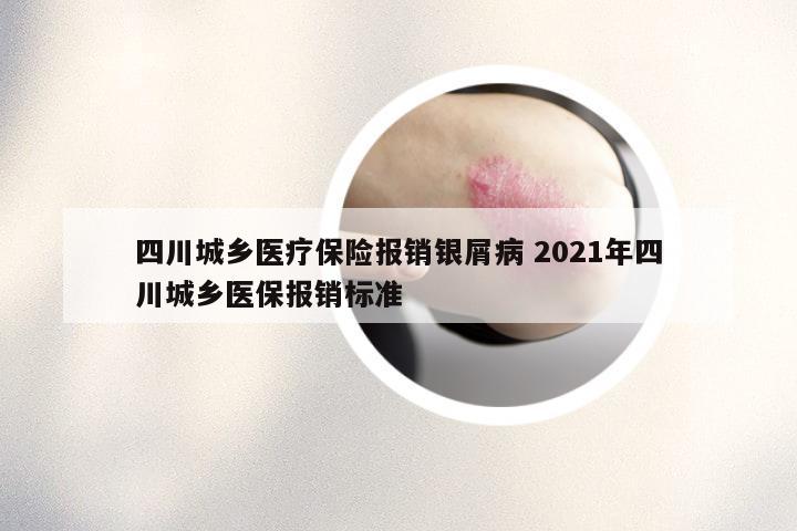 四川城乡医疗保险报销银屑病 2021年四川城乡医保报销标准