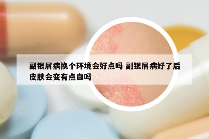 副银屑病换个环境会好点吗 副银屑病好了后皮肤会变有点白吗