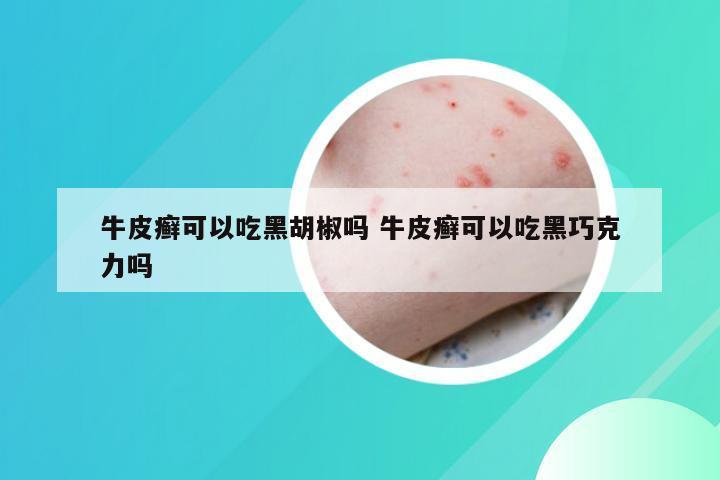 牛皮癣可以吃黑胡椒吗 牛皮癣可以吃黑巧克力吗