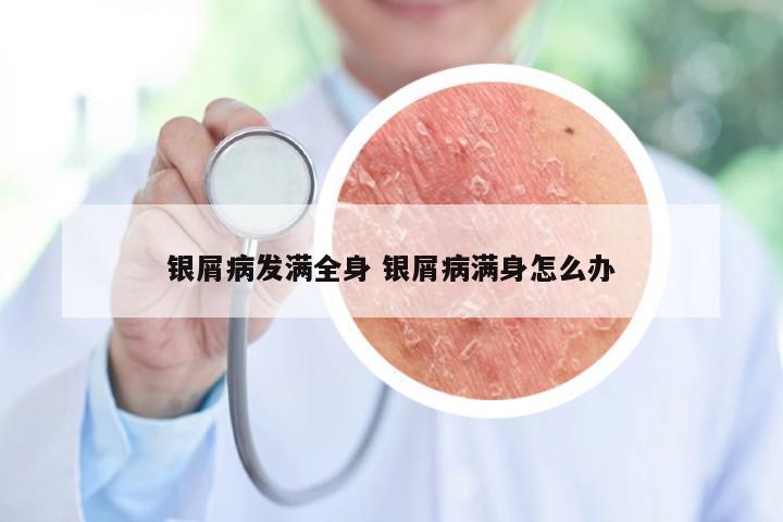 银屑病发满全身 银屑病满身怎么办