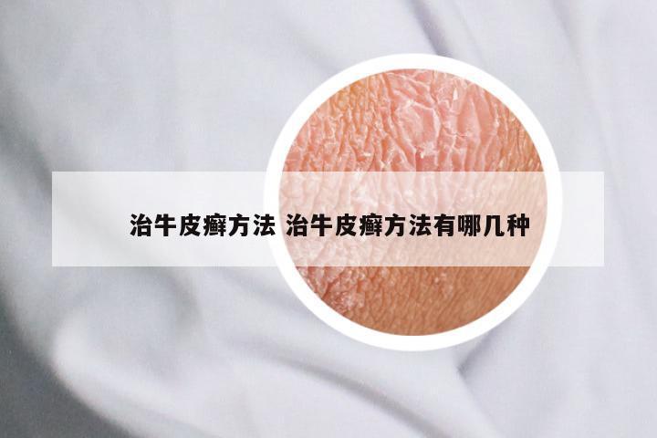 治牛皮癣方法 治牛皮癣方法有哪几种