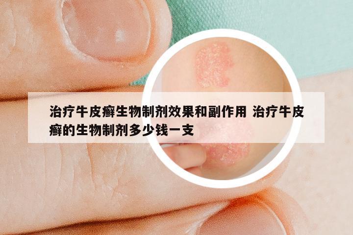 治疗牛皮癣生物制剂效果和副作用 治疗牛皮癣的生物制剂多少钱一支