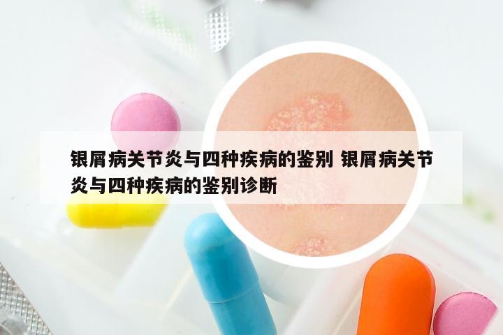 银屑病关节炎与四种疾病的鉴别 银屑病关节炎与四种疾病的鉴别诊断