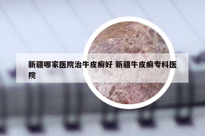 新疆哪家医院治牛皮癣好 新疆牛皮癣专科医院