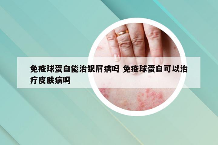 免疫球蛋白能治银屑病吗 免疫球蛋白可以治疗皮肤病吗