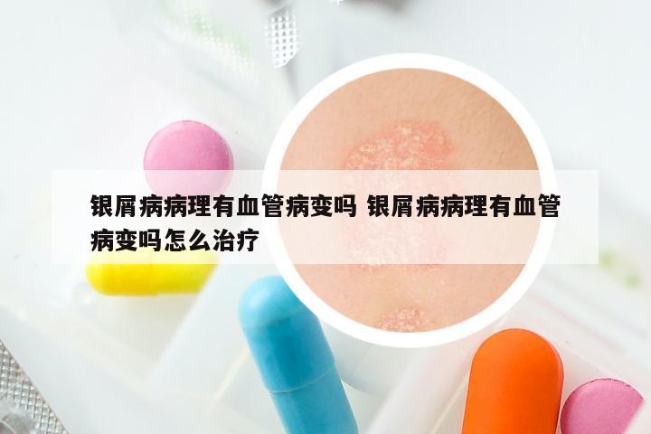 银屑病病理有血管病变吗 银屑病病理有血管病变吗怎么治疗