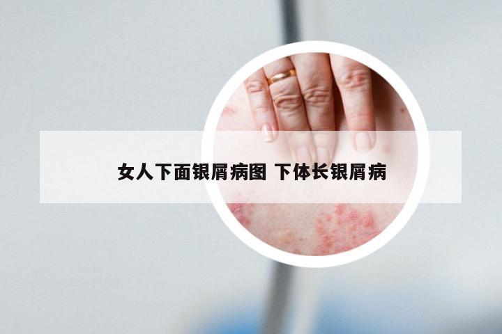 女人下面银屑病图 下体长银屑病