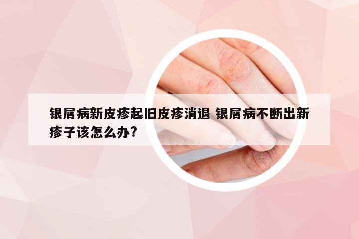 银屑病新皮疹起旧皮疹消退 银屑病不断出新疹子该怎么办?