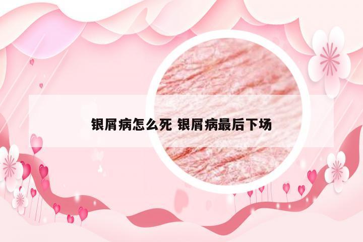 银屑病怎么死 银屑病最后下场