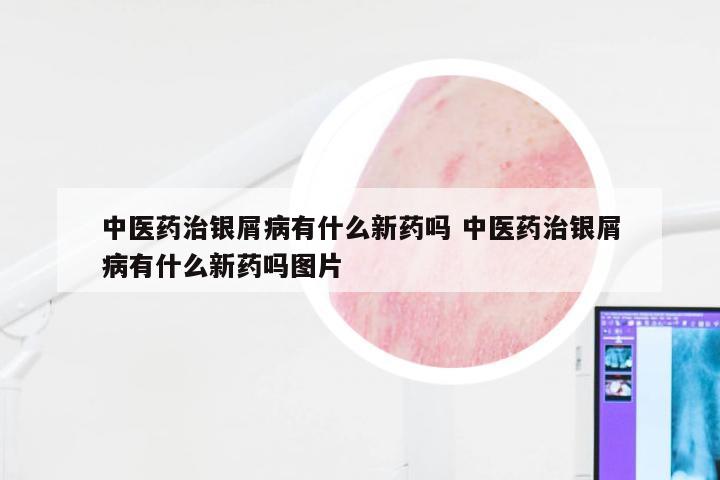 中医药治银屑病有什么新药吗 中医药治银屑病有什么新药吗图片