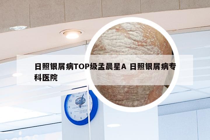 日照银屑病TOP级孟晨星A 日照银屑病专科医院