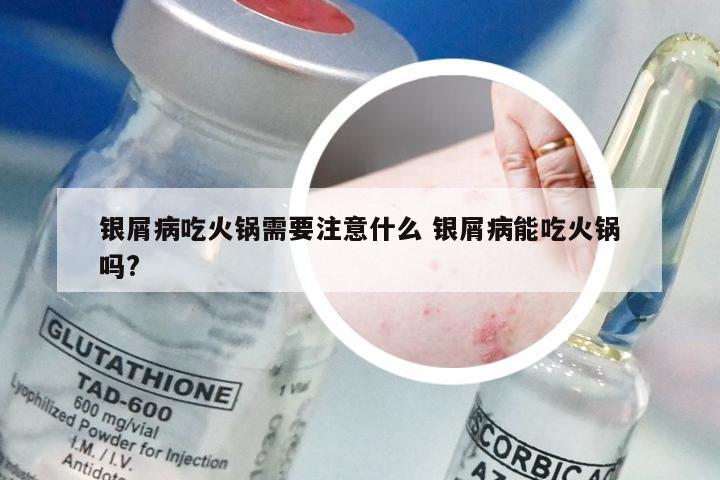 银屑病吃火锅需要注意什么 银屑病能吃火锅吗?