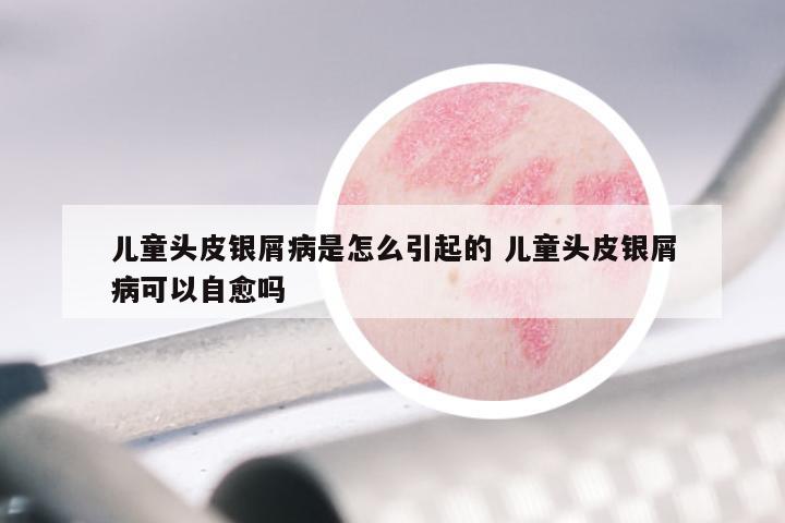 儿童头皮银屑病是怎么引起的 儿童头皮银屑病可以自愈吗