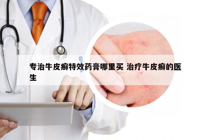 专治牛皮癣特效药膏哪里买 治疗牛皮癣的医生
