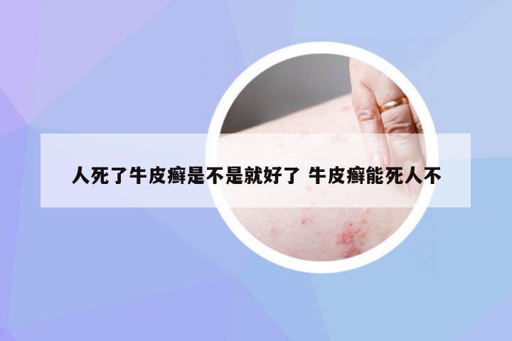人死了牛皮癣是不是就好了 牛皮癣能死人不