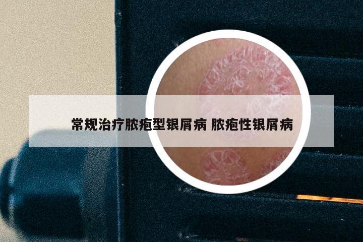 常规治疗脓疱型银屑病 脓疱性银屑病