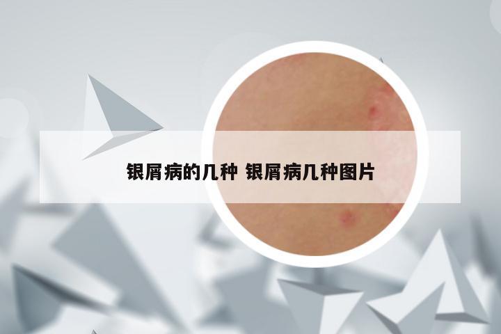 银屑病的几种 银屑病几种图片