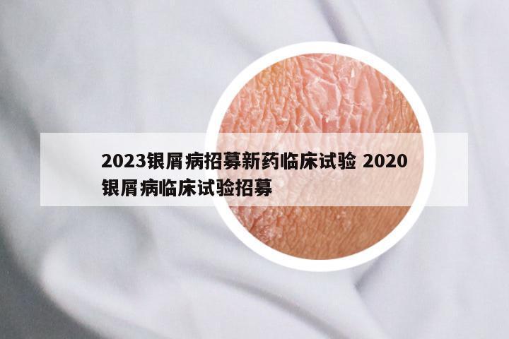 2023银屑病招募新药临床试验 2020银屑病临床试验招募