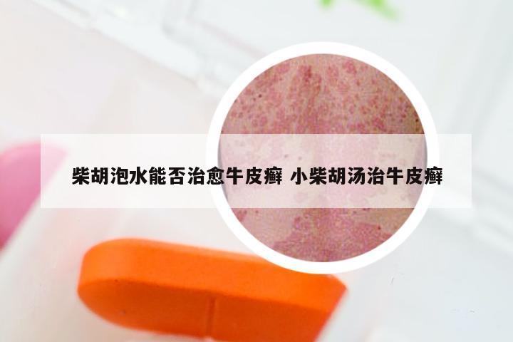 柴胡泡水能否治愈牛皮癣 小柴胡汤治牛皮癣