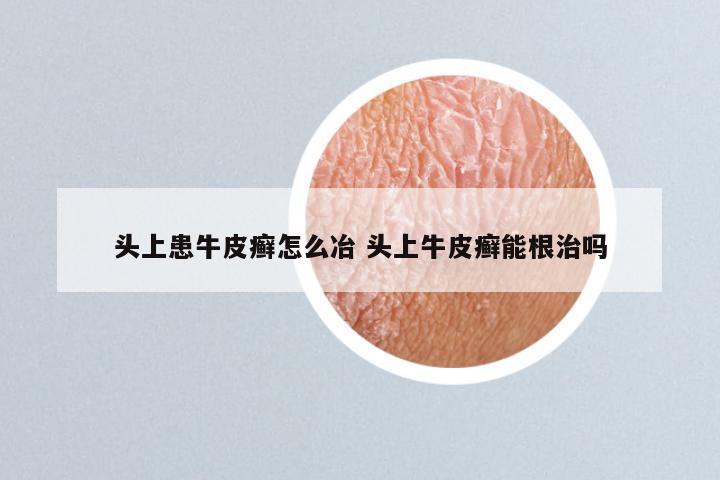 头上患牛皮癣怎么冶 头上牛皮癣能根治吗