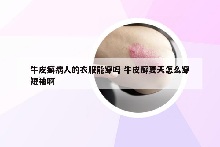 牛皮癣病人的衣服能穿吗 牛皮癣夏天怎么穿短袖啊