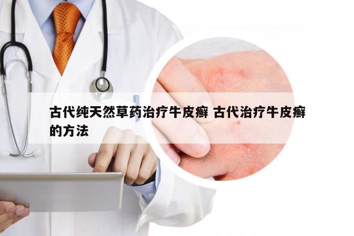 古代纯天然草药治疗牛皮癣 古代治疗牛皮癣的方法