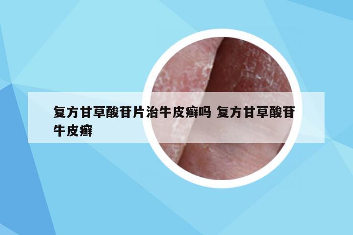 复方甘草酸苷片治牛皮癣吗 复方甘草酸苷 牛皮癣