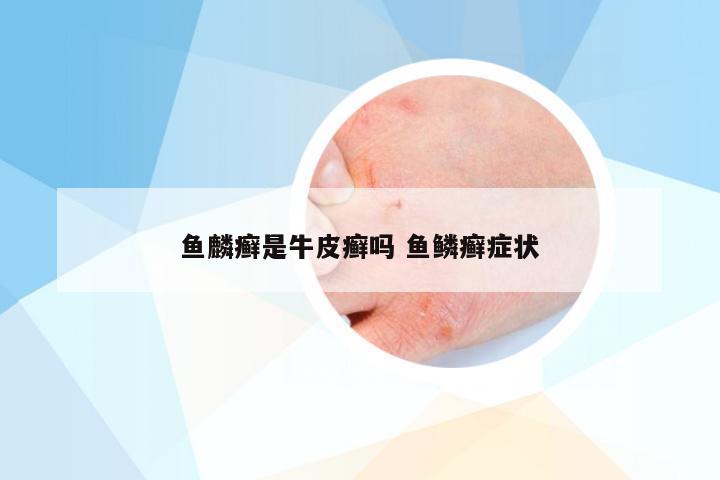 鱼麟癣是牛皮癣吗 鱼鳞癣症状