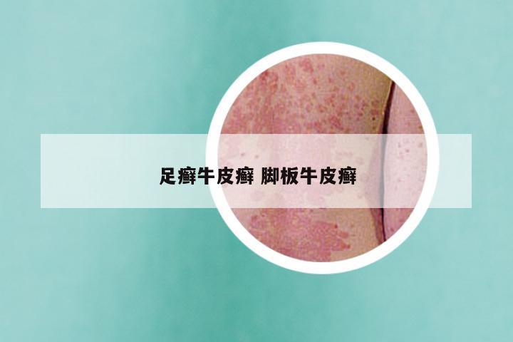 足癣牛皮癣 脚板牛皮癣