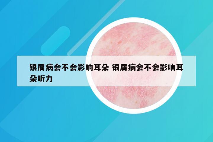 银屑病会不会影响耳朵 银屑病会不会影响耳朵听力