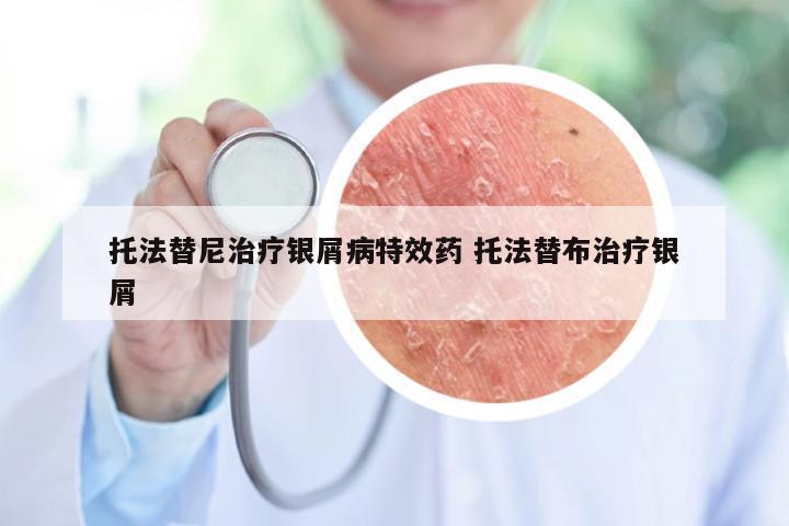托法替尼治疗银屑病特效药 托法替布治疗银屑