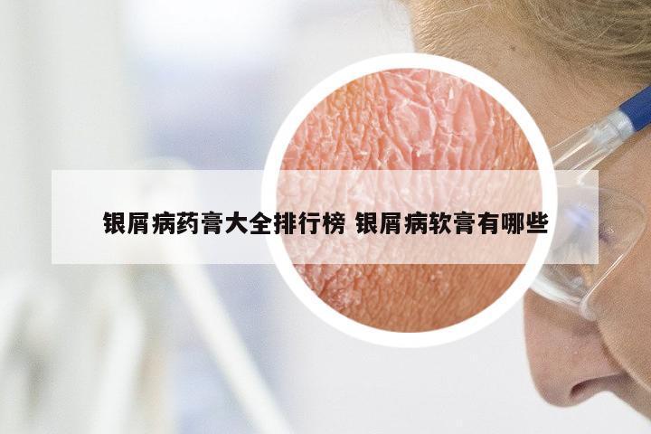 银屑病药膏大全排行榜 银屑病软膏有哪些