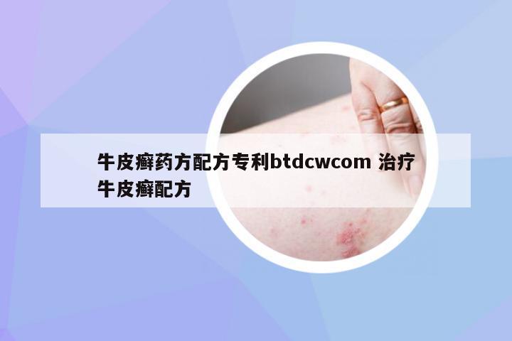 牛皮癣药方配方专利btdcwcom 治疗牛皮癣配方