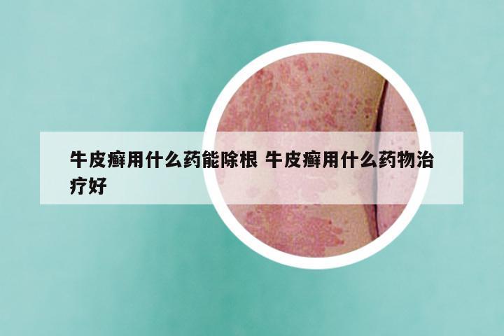 牛皮癣用什么药能除根 牛皮癣用什么药物治疗好