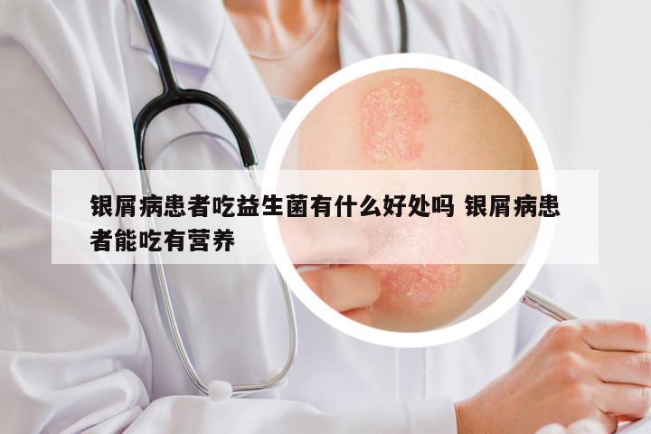 银屑病患者吃益生菌有什么好处吗 银屑病患者能吃有营养