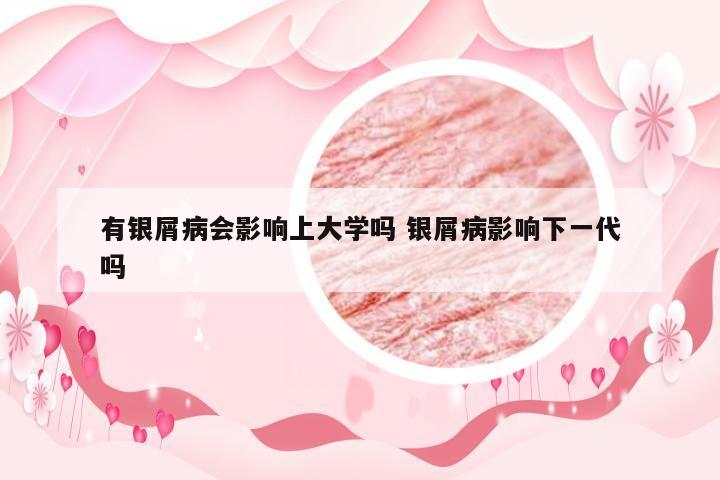 有银屑病会影响上大学吗 银屑病影响下一代吗