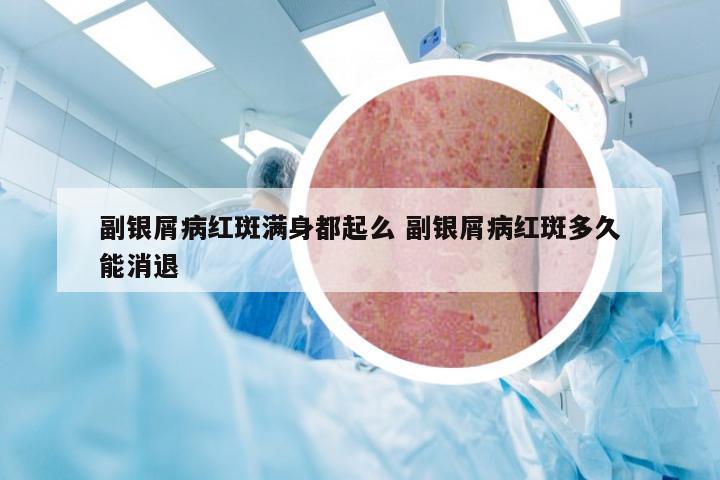 副银屑病红斑满身都起么 副银屑病红斑多久能消退
